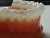 Invisalign® Clear Aligners