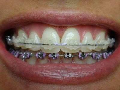 Clear Braces