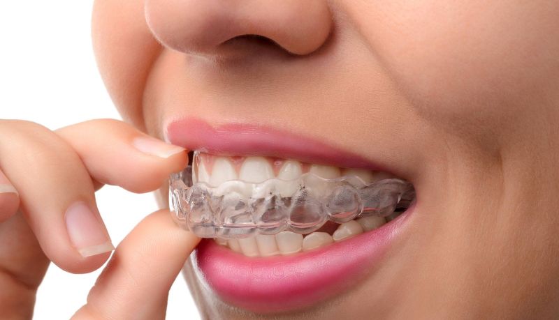 Clear Aligners