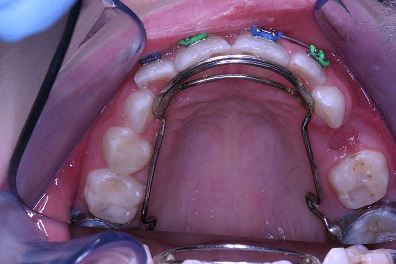 Tongue Crib