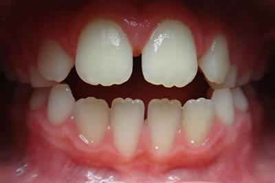 Anterior open bite
