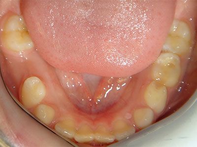 baby teeth