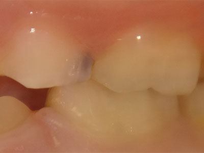 cavity