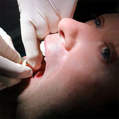 IPR – Interproximal Reduction