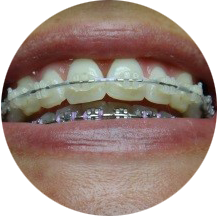 CLEAR BRACES
