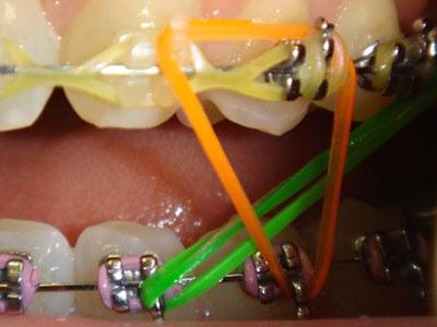 Elastics pattern