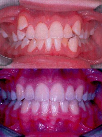 extraction of permanent teeth