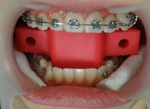 BRACES