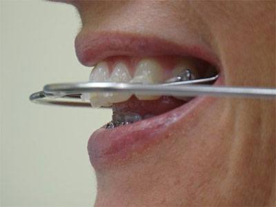 Ortho Headgear side