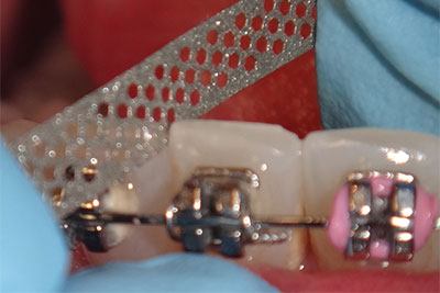 a small, sandpaper-like strip between the teeth