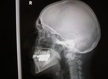 x-ray