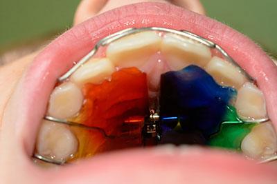Metal Plate on Palate