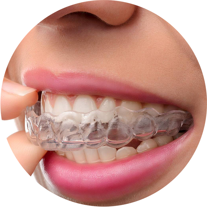 Alternatives to Traditional Braces