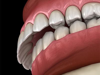 Overbite