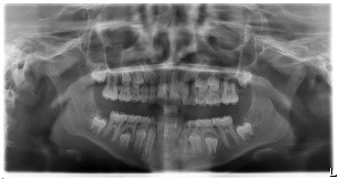 x-ray