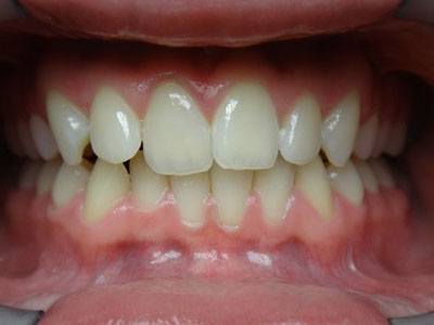 Teeth 2