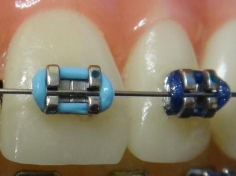 TRADITIONAL METAL BRACKETS