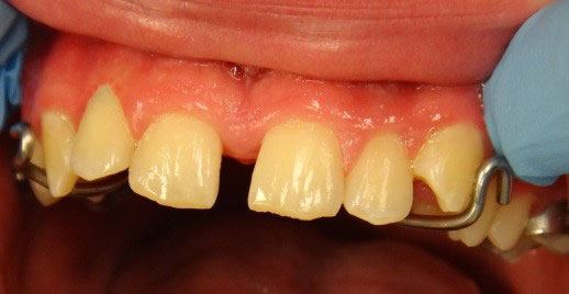 upper dental arch
