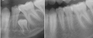 Jaw Xray