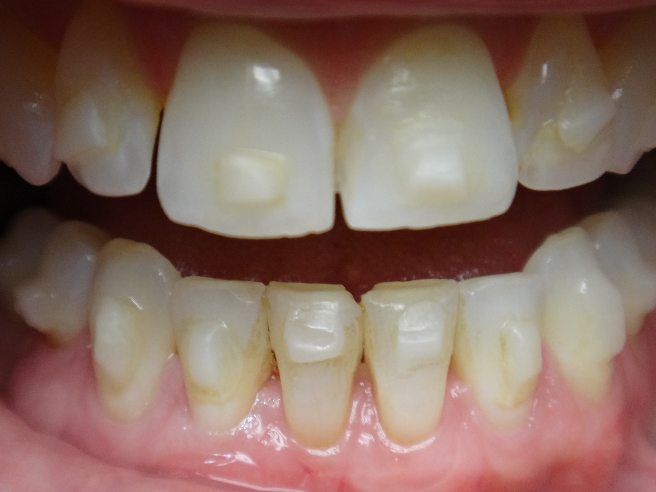 Invisalign