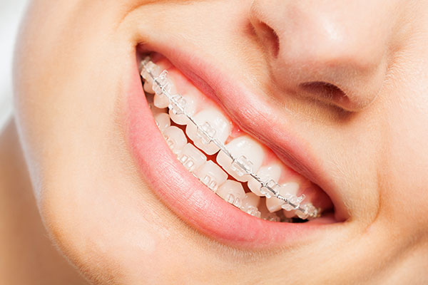 Braces