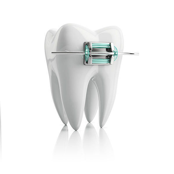 Braces