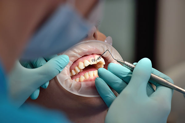 Braces install