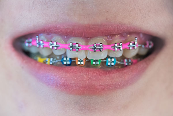 Spring Retainer