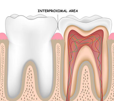 Interproximal Reduction