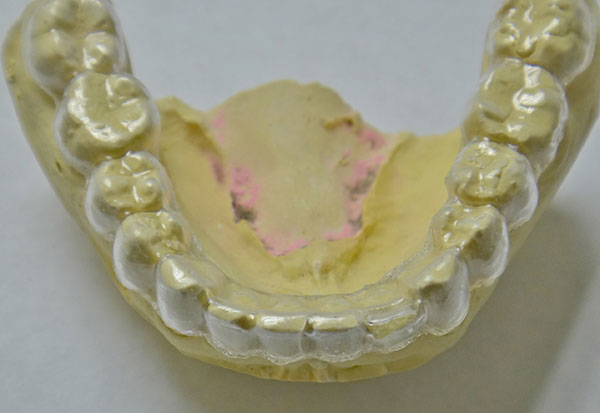 MTM Clear Aligners