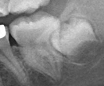 Rear X-Rays