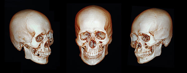 Skull