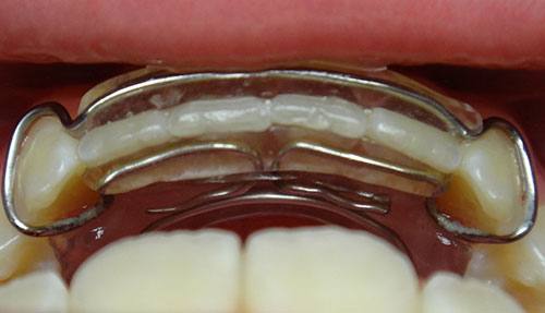 Spring Retainer