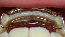 Spring Retainers