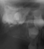 mummy braces