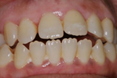 Redhead with Braces Smiling