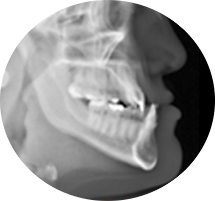 CLEAR BRACES