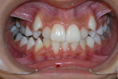 Clear Braces