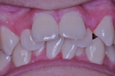 Redhead with Braces Smiling