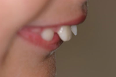 Clear Braces