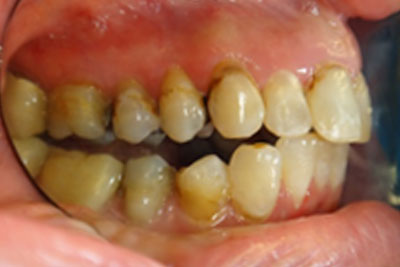Clear Braces