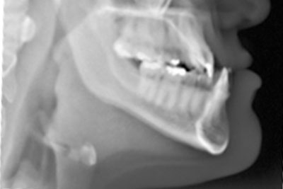 Clear Braces