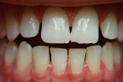 Clear Braces