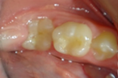 Spring Retainer
