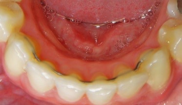Debonding Appointment
