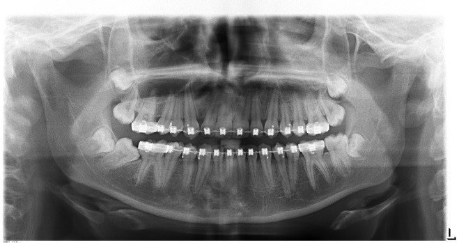 Debonding Appointment