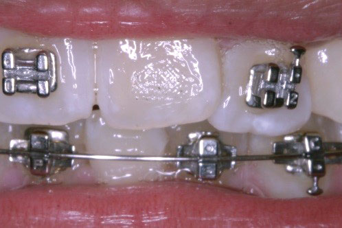 Emergency Orthodontic Care