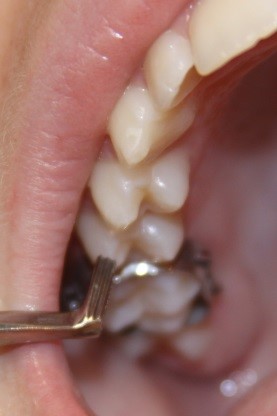 Expander
