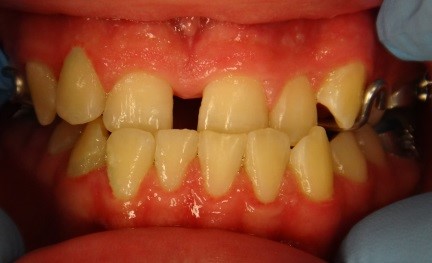 Expander