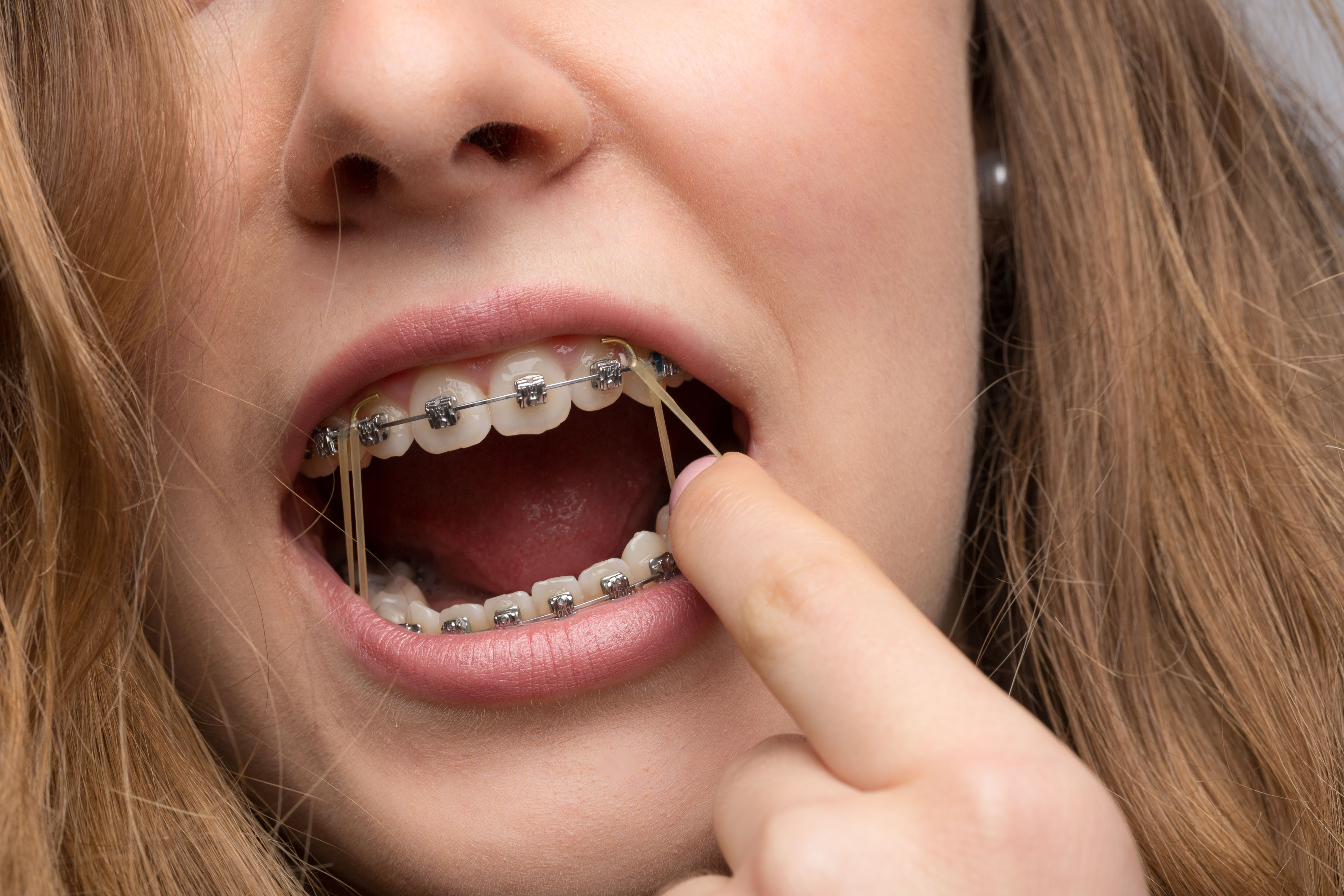 Braces